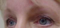 brow lift and eyelid surgery after photo