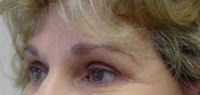 endoscopic brow lift after photo