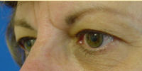 brow lift before photo