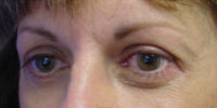 brow lift after photo