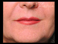 restylane after photo