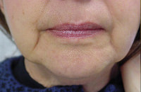 restylane before photo