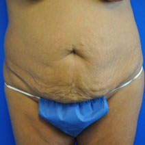 abdominoplasty and flank liposuction before photo