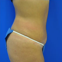 abdominoplasty and flank liposuction after photo
