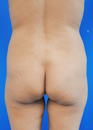 liposuction and fat transfer before photo