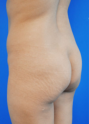 liposuction and fat transfer before photo