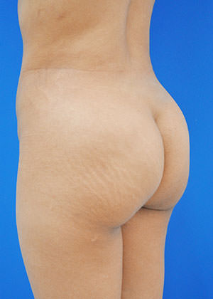 liposuction and fat transfer after photo