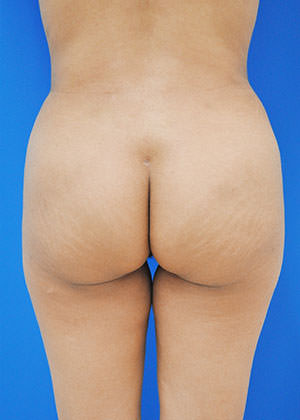 liposuction and fat transfer after photo