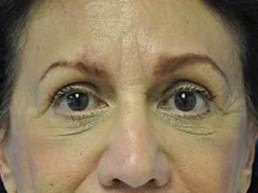 upper and lower blepharoplasty after photo