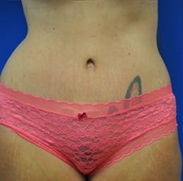 tummy tuck after photo