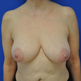 breast lift mastopexy before photo