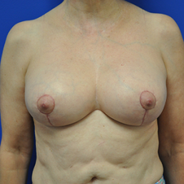 breast lift mastopexy after photo