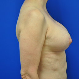 breast lift mastopexy after photo
