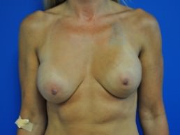 revisional corrective breast augmentation before photo