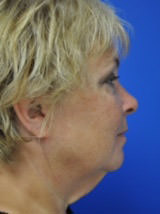 lower face and neck lift before photo
