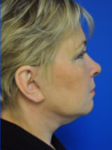 lower face and neck lift after photo