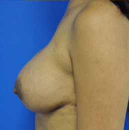revisional corrective breast augmentation after photo