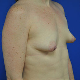 complex primary breast augmentation before photo