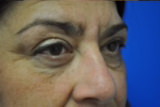 bilateral upper and lower lid surgery before photo