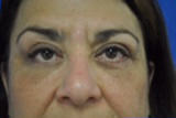 bilateral upper and lower lid surgery after photo