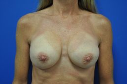 combination breast lift augmentation after photo