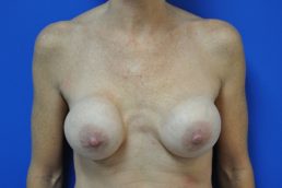 combination breast lift augmentation before photo