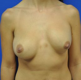revisional corrective breast augmentation before photo