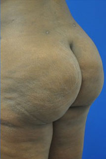 buttock shaping after photo
