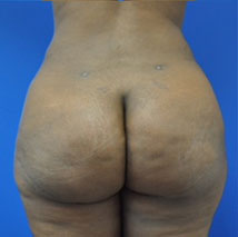 buttock shaping after photo
