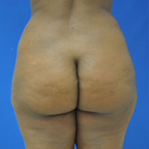 buttock shaping before photo