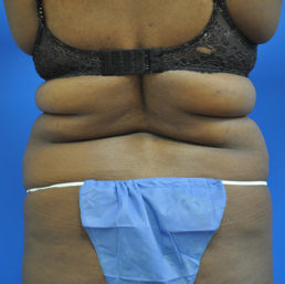 liposuction before photo