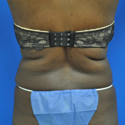 liposuction after photo