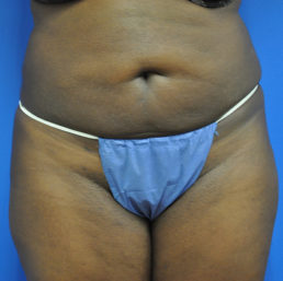 liposuction after photo