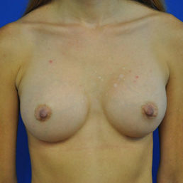 breast augmentation after photo