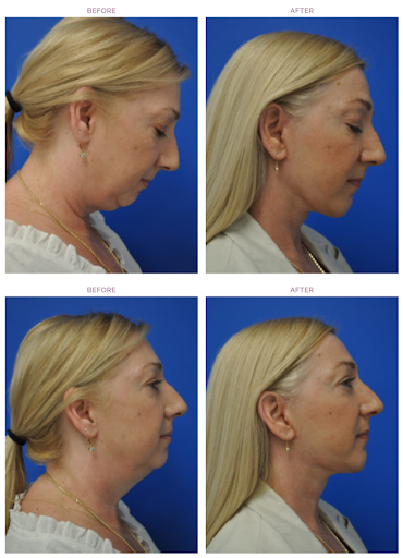 Facelift Patient Case Study Restoring Jawline Definition and a Youthful Profile