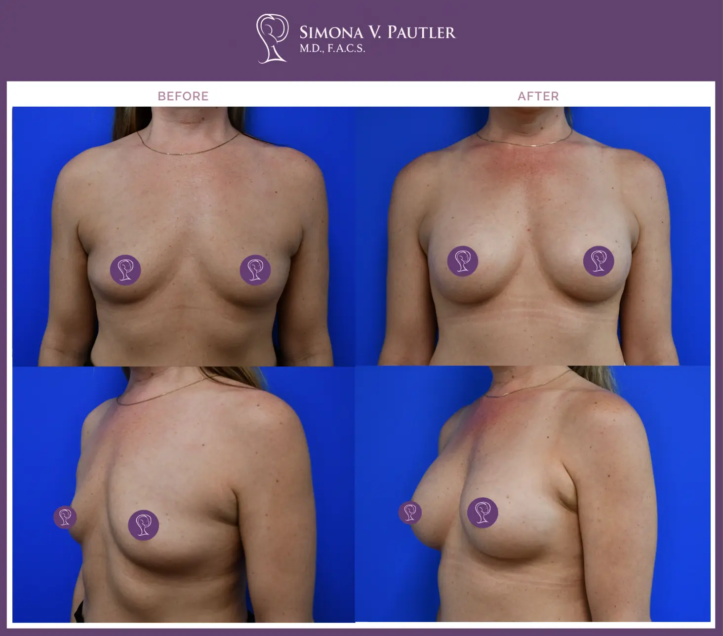 breast implant patient before and after photo